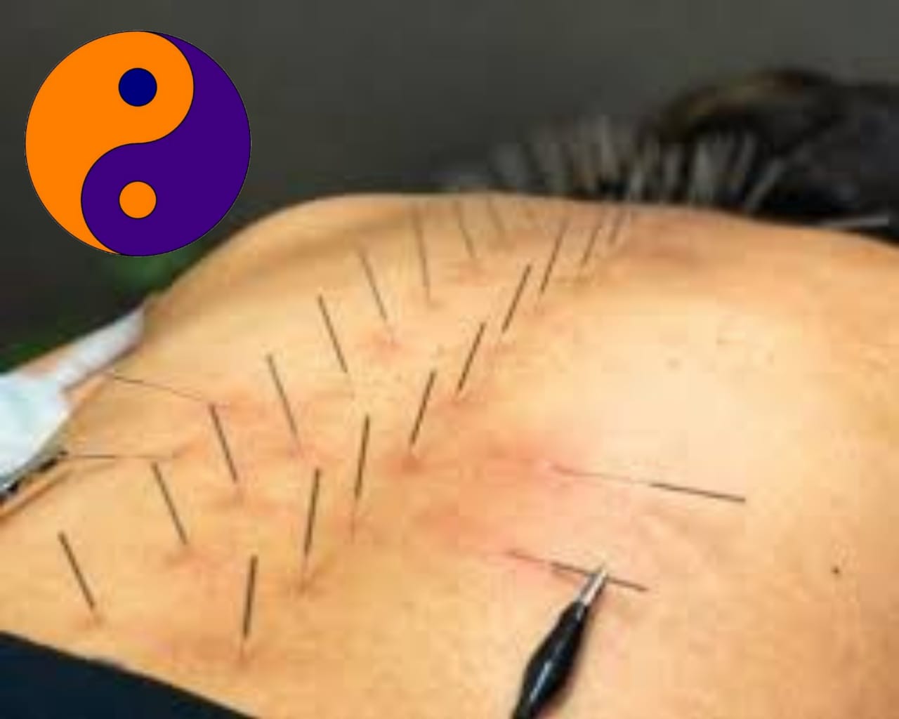 ACUPUNCTURE CLINIC PEYAD TVM